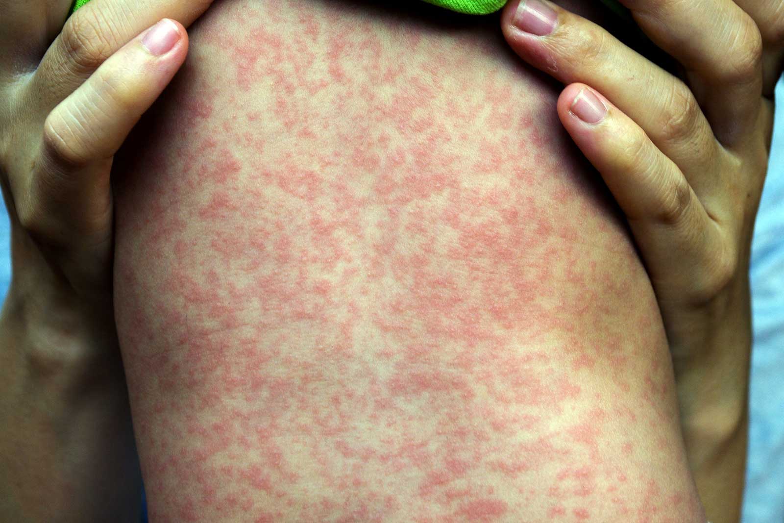  Seizure Drug Rash